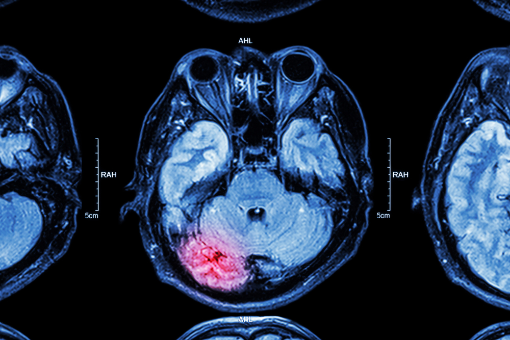 Disability types caused by traumatic brain injuries in Houston Texas